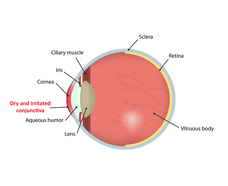 Dry Eye Treatment Mansfield Tx Advanced Vision Care